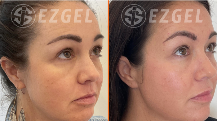 facial smoothing